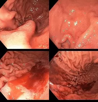 Висмут ассоциированная гастропатия тела желудка. . Атлас эндоскопических изображений endoatlas