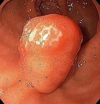 Рецидив гиперпластического полипа антрального отдела желудка. Атлас эндоскопических изображений endoatlas