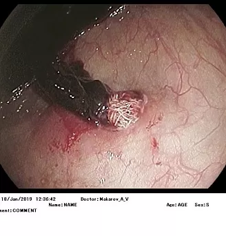Ятрогенное повреждение толстой кишки (марлевый тампон). Атлас эндоскопических изображений endoatlas