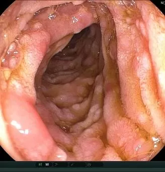 Лямблиоз ДПК.. Атлас эндоскопических изображений endoatlas