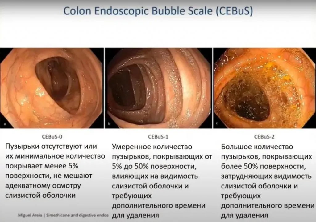 Colon_Endoscopic_Bubble_Scale_CEBuS_EndoExpert.ru.jpg