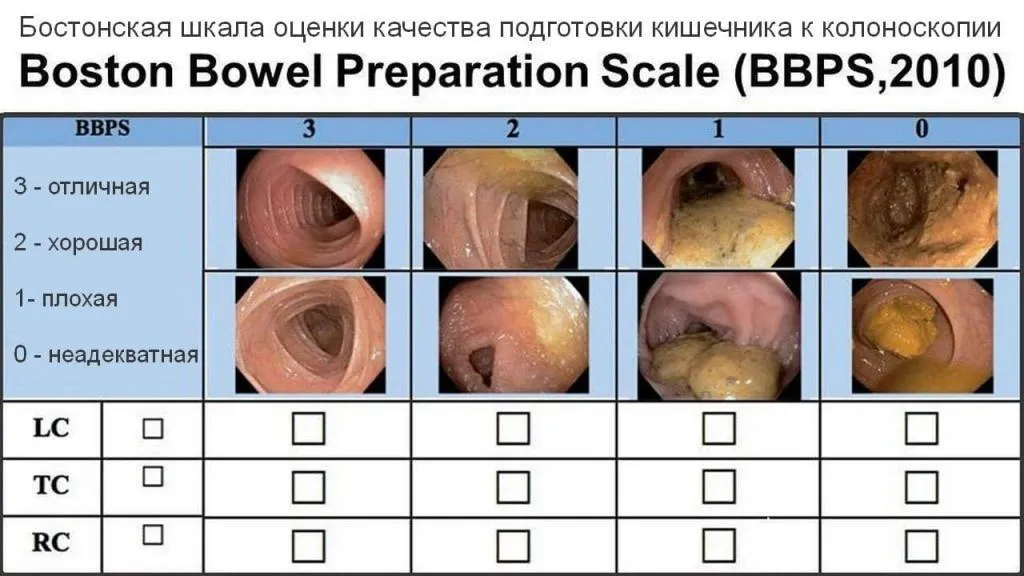 BBPS (Boston Bowel Preparation Scale) — шкала для оценки уровня очистки толстой кишки Бостон, excellent — отличная, good — хорошая, poor — плохая, inadequate — неадекватная, LC (left colon) — левые отделы кишки, TC (transverse colon) — поперечные отделы кишки, RC (right colon) — правые отделы кишки.