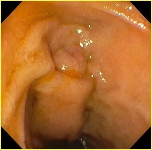 Вид БДС при дуоденоскопии после резекции желудка по_Бильрот-2. Атлас эндоскопических изображений endoatlas